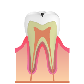 虫歯の初期段階（C1まで）