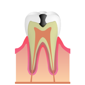 虫歯の中期段階（C2）