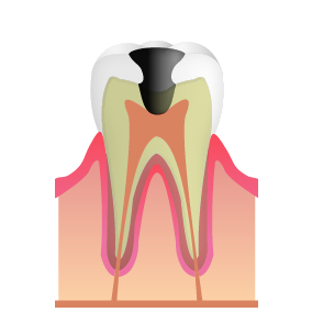 虫歯の後期段階（C3）