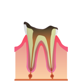 虫歯の末期段階（C4）