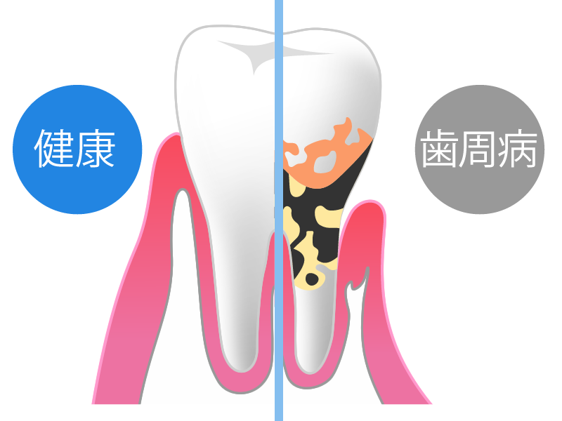 歯周病とは（体に及ぼす影響など）